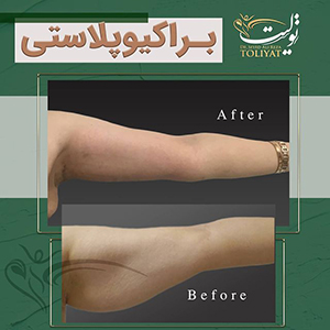 براکیوپلاستی