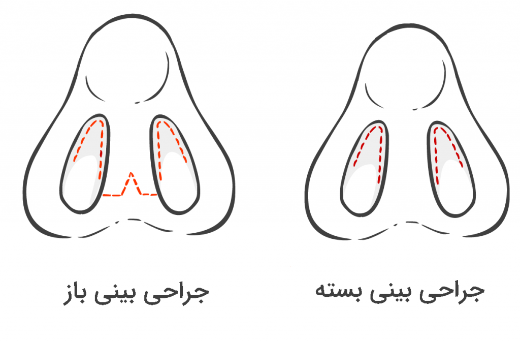 تفاوت جراحی بینی باز و بسته