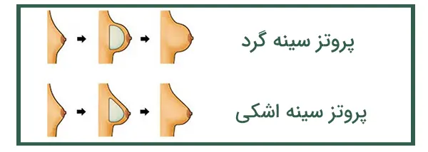 انواع پروتز سینه