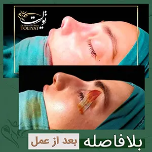 تصویر جراحی بینی
