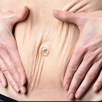 چین خوردگی شکم