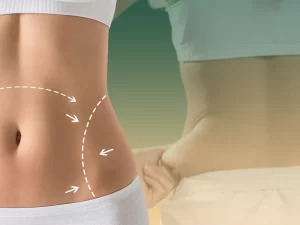 ابدومینوپلاستی