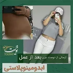 جراحی ابدومینوپلاستی