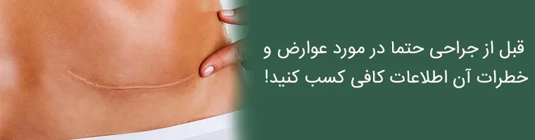 عوارض ابدومینوپلاستی