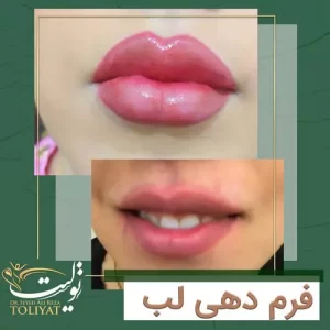 تصویر فرم دهی به لب