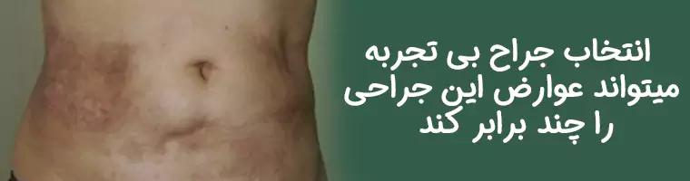 عوارض-جراحی-ابدومینوپلاستی