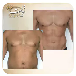 لیپوماتیک سینه