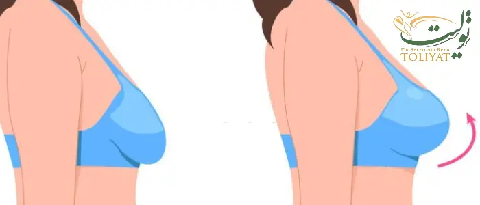 پروتز سینه همزمان با لیفت سینه